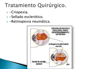 



-Criopexia.
-Sellado esclerótico.
-Retinopexia neumática.

 