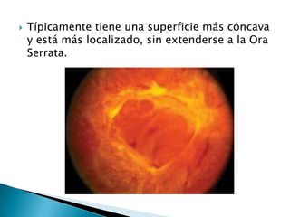 

Típicamente tiene una superficie más cóncava
y está más localizado, sin extenderse a la Ora
Serrata.

 