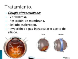 





Cirugía vitreoretiniana:
-Vitrectomía.
-Resección de membrana.
-Sellado esclerótico.
-Inyección de gas intraocular o aceite de
silicón.

 