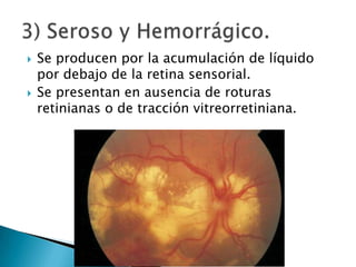 



Se producen por la acumulación de líquido
por debajo de la retina sensorial.
Se presentan en ausencia de roturas
retinianas o de tracción vitreorretiniana.

 