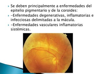 





Se deben principalmente a enfermedades del
epitelio pigmentario y de la coroides:
-Enfermedades degenerativas, inflamatorias e
infecciosas delimitadas a la mácula.
-Enfermedades vasculares inflamatorias
sistémicas.

 