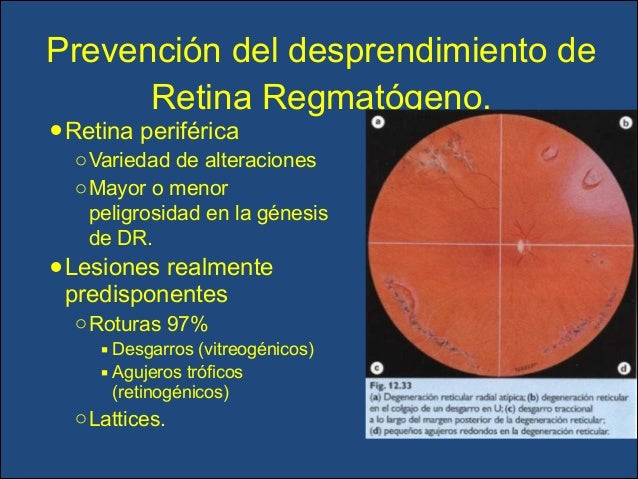 Lesiones Predisponentes A Desprendimiento De Retina es.slideshare.net