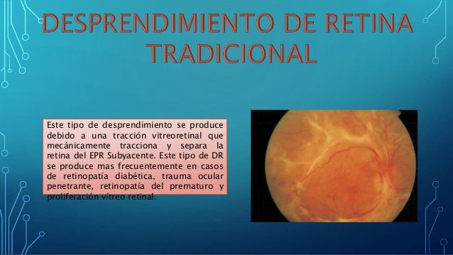 Desprendimiento de retina Desprendimiento de retina