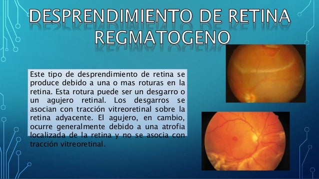 Desprendimiento de retina Desprendimiento de retina
