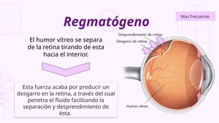 Regmatógeno
Mas frecuente
El humor vítreo se separa
de la retina tirando de esta
hacia el interior.
Esta fuerza acaba por producir un
desgarro en la retina, a través del cual
penetra el fluido facilitando la
separación y desprendimiento de
ésta.
 
