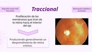 Traccional Retinopatía diabética
avanzada
Proliferación de las
membranas que tiran de
la retina hacia el interior
del ojo
Produciendo generalmente un
desprendimiento de retina
crónico.
Segunda causa más
frecuente
 