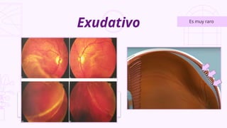Exudativo Es muy raro
Se origina por la
inflamación del epitelio
pigmentario y coroides que
producen líquido
Acumulándose bajo la retina,
separándola de las capas
inferiores
 