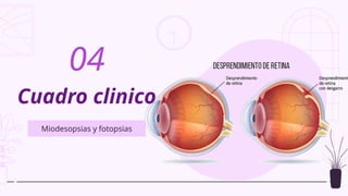 Cuadro clinico
Miodesopsias y fotopsias
04
 
