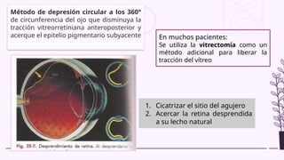 Método de depresión circular a los 360°
de circunferencia del ojo que disminuya la
tracción vitreorretiniana anteroposterior y
acerque el epitelio pigmentario subyacente En muchos pacientes:
Se utiliza la vitrectomía como un
método adicional para liberar la
tracción del vítreo
1. Cicatrizar el sitio del agujero
2. Acercar la retina desprendida
a su lecho natural
 