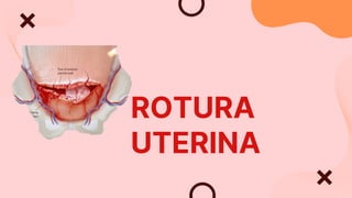 ROTURA
UTERINA
 