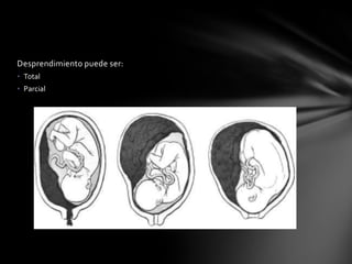 Desprendimiento puede ser:
• Total
• Parcial
 