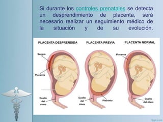 Desprendimiento prematuro de placenta