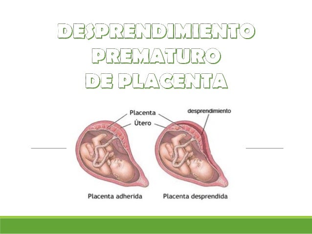 Desprendimiento prematuro de placenta
