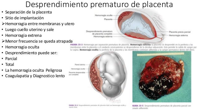 Desprendimiento prematuro de placenta