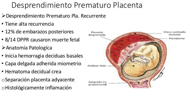 Desprendimiento prematuro de placenta