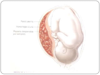 Desprendimiento prematuro de placenta normoinserta
