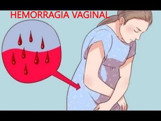 HEMORRAGIA VAGINAL
 