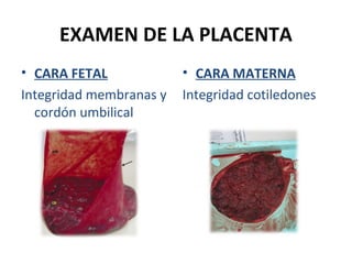 EXAMEN DE LA PLACENTA
• CARA FETAL
Integridad membranas y
cordón umbilical

• CARA MATERNA
Integridad cotiledones

 