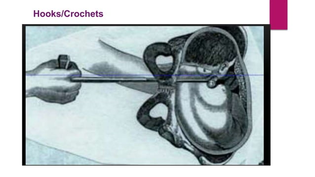 Destructive operations | PPTX | Pregnancy | Reproductive Health