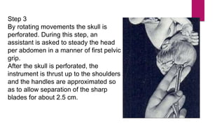 Step 3
By rotating movements the skull is
perforated. During this step, an
assistant is asked to steady the head
per abdomen in a manner of first pelvic
grip.
After the skull is perforated, the
instrument is thrust up to the shoulders
and the handles are approximated so
as to allow separation of the sharp
blades for about 2.5 cm.
 