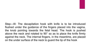 Step—III: The decapitation hook with knife is to be introduced
flushed under the guidance of the fingers placed into the vagina,
the knob pointing towards the fetal head. The hook is pushed
above the neck and rotated to 90° so as to place the knife firmly
against the neck. The internal fingers, in the meantime, are placed
on the under surface of the neck to guard the tip of the hook
 