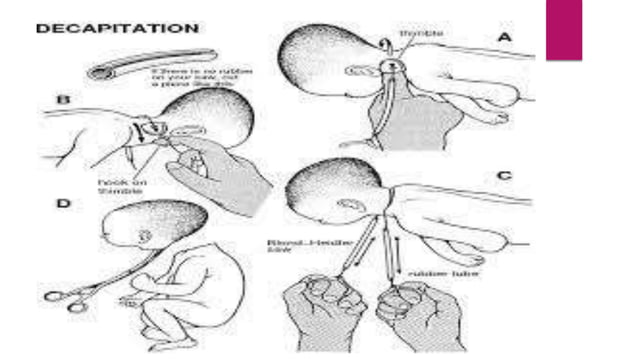 Destructive operations | PPTX | Pregnancy | Reproductive Health