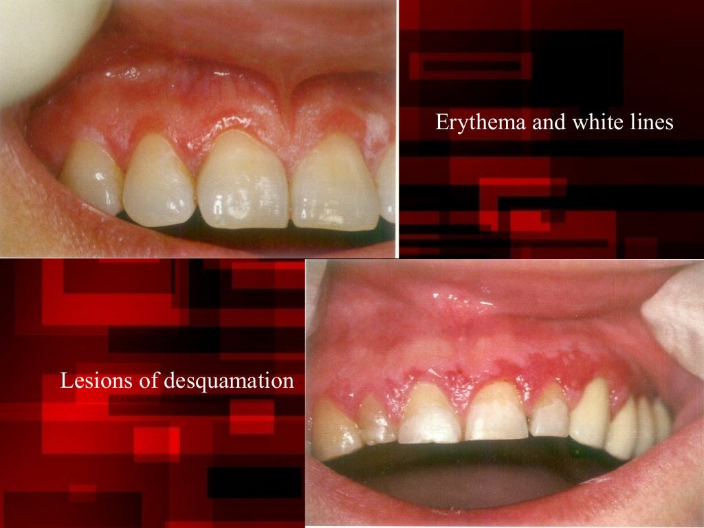 Desquamative gingivitis