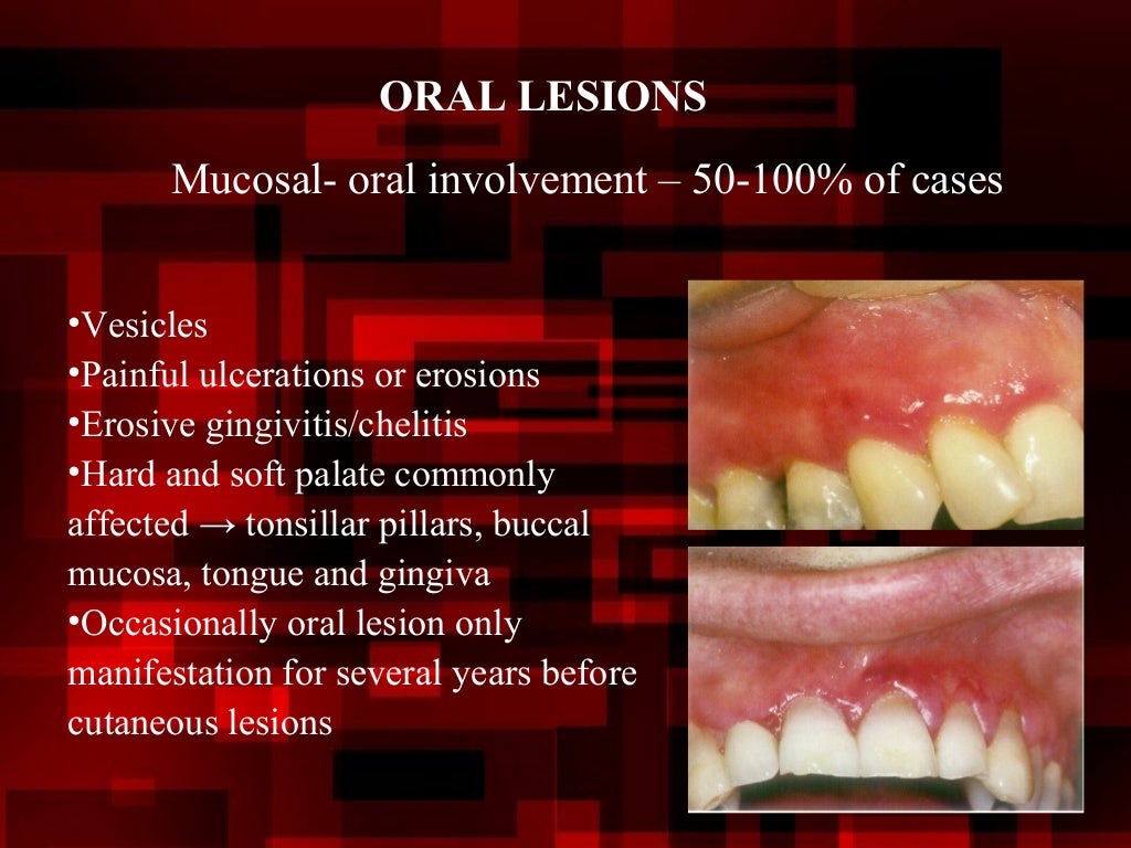 Desquamative gingivitis