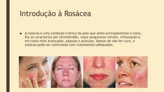 Introdução à Rosácea
■ A rosácea é uma condição crônica da pele que afeta principalmente o rosto.
Ela se caracteriza por vermelhidão, vasos sanguíneos visíveis, inflamação e,
em casos mais avançados, pápulas e pústulas. Apesar de não ter cura, a
rosácea pode ser controlada com tratamentos adequados.
 