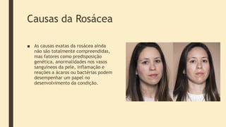 Causas da Rosácea
■ As causas exatas da rosácea ainda
não são totalmente compreendidas,
mas fatores como predisposição
genética, anormalidades nos vasos
sanguíneos da pele, inflamação e
reações a ácaros ou bactérias podem
desempenhar um papel no
desenvolvimento da condição.
 