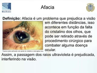 em diferentes distâncias, isso
acontece em função da falta
do cristalino dos olhos, que
pode ser retirado através de
procedimento cirúrgico para
combater alguma doença
ocular.
Definição: Afacia é um problema que prejudica a visão
Afacia
 