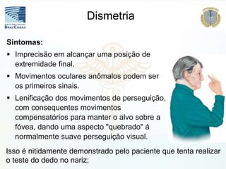Isso é nitidamente demonstrado pelo paciente que tenta realizar
o teste do dedo no nariz;
Sintomas:
 Imprecisão em alcançar uma posição de
extremidade final.
 Movimentos oculares anômalos podem ser
os primeiros sinais.
 Lenificação dos movimentos de perseguição,
com consequentes movimentos
compensatórios para manter o alvo sobre a
fóvea, dando uma aspecto "quebrado" á
normalmente suave perseguição visual.
Dismetria
 