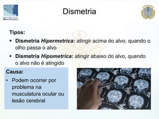 .
Dismetria
Tipos:
 Dismetria Hipermetrica: atingir acima do alvo, quando o
olho passa o alvo
 Dismetria Hipometrica: atingir abaixo do alvo, quando
o alvo não é atingido
Causa:
• Podem ocorrer por
problema na
musculatura ocular ou
lesão cerebral
 