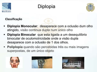 Diplopia Monocular: desaparece com a oclusão dum olho
atingido, visão continua dupla num único olho
 Diplopia Binocular que esta ligada a um desequilíbrio
binocular de oculomotricidade onde a visão dupla
desaparece com a oclusão de 1 dos olhos.
 Poliplopia quando são percebidas três ou mais imagens
superpostas, de um único objeto
Classificação
Diplopia
 