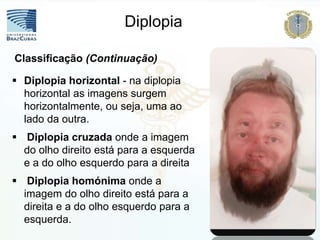  Diplopia horizontal - na diplopia
horizontal as imagens surgem
horizontalmente, ou seja, uma ao
lado da outra.
 Diplopia cruzada onde a imagem
do olho direito está para a esquerda
e a do olho esquerdo para a direita
 Diplopia homónima onde a
imagem do olho direito está para a
direita e a do olho esquerdo para a
esquerda.
Classificação (Continuação)
Diplopia
 