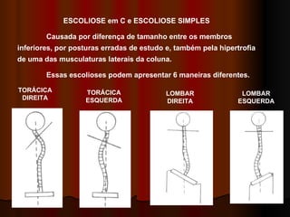 ESCOLIOSE em C e ESCOLIOSE SIMPLES Causada por diferença de tamanho entre os membros inferiores, por posturas erradas de estudo e, também pela hipertrofia de uma das musculaturas laterais da coluna.  Essas escolioses podem apresentar 6 maneiras diferentes. TORÁCICA DIREITA TORÁCICA ESQUERDA LOMBAR DIREITA LOMBAR ESQUERDA 