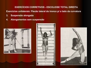 EXERCÍCIOS CORRETIVOS - ESCOLIOSE TOTAL DIREITA Exercícios unilaterais: Flexão lateral do tronco p/ o lado da curvatura Suspensão alongada Alongamentos sem suspensão 