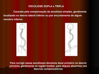 ESCOLIOSE DUPLA e TRIPLA Causada pela compensação da escoliose simples, geralmente localizada no desvio lateral inferior ou por encurtamento de algum membro inferior. Para corrigir essas escolioses devemos atuar primeiro no desvio primário, geralmente na região lombar, para depois atuarmos nos desvios compensatórios 