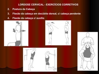 LORDOSE CERVICAL - EXERCÍCIOS CORRETIVOS Postura da Cabeça Flexão da cabeça em decúbito dorsal, c/ cabeça pendente Flexão da cabeça c/ auxílio 1 3 2 2 
