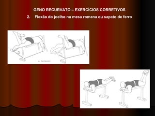 GENO RECURVATO – EXERCÍCIOS CORRETIVOS Flexão do joelho na mesa romana ou sapato de ferro 