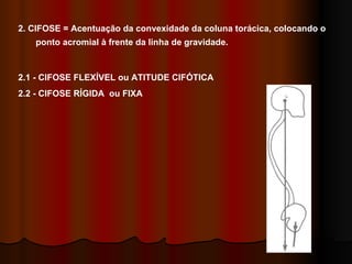 2. CIFOSE = Acentuação da convexidade da coluna torácica, colocando o ponto acromial à frente da linha de gravidade. 2.1 - CIFOSE FLEXÍVEL ou ATITUDE CIFÓTICA 2.2 - CIFOSE RÍGIDA  ou FIXA 