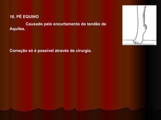 16. PÉ EQUINO Causado pelo encurtamento do tendão de Aquiles. Correção só é possível através de cirurgia. 