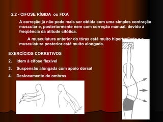 2.2 - CIFOSE RÍGIDA  ou FIXA  A correção já não pode mais ser obtida com uma simples contração muscular e, posteriormente nem com correção manual, devido à freqüência da atitude cifótica. A musculatura anterior do tórax está muito hipertrofiada e a musculatura posterior está muito alongada. EXERCÍCIOS CORRETIVOS Idem à cifose flexível Suspensão alongada com apoio dorsal Deslocamento de ombros 2 3 