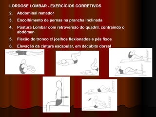 LORDOSE LOMBAR - EXERCÍCIOS CORRETIVOS Abdominal remador Encolhimento de pernas na prancha inclinada Postura Lombar com retroversão do quadril, contraindo o abdômen Flexão do tronco c/ joelhos flexionados e pés fixos Elevação da cintura escapular, em decúbito dorsal 1 2 3 5 4 