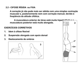 2.2 - CIFOSE RÍGIDA ou FIXA
      A correção já não pode mais ser obtida com uma simples contração
      muscular e, posteriormente nem com correção manual, devido à
      freqüência da atitude cifótica.
         A musculatura anterior do tórax está muito hipertrofiada e a
      musculatura posterior está muito alongada.                      2

EXERCÍCIOS CORRETIVOS
1.   Idem à cifose flexível
2.   Suspensão alongada com apoio dorsal
3.   Deslocamento de ombros

                                   3
 