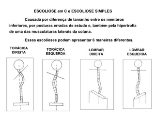 ESCOLIOSE em C e ESCOLIOSE SIMPLES

        Causada por diferença de tamanho entre os membros
inferiores, por posturas erradas de estudo e, também pela hipertrofia
de uma das musculaturas laterais da coluna.

        Essas escolioses podem apresentar 6 maneiras diferentes.

TORÁCICA           TORÁCICA                LOMBAR                LOMBAR
 DIREITA           ESQUERDA                DIREITA              ESQUERDA
 