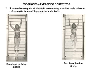 ESCOLIOSES – EXERCÍCIOS CORRETIVOS
3. Suspensão alongada c/ elevação do ombro que estiver mais baixo ou
    c/ elevação do quadril que estiver mais baixo




Escoliose toráxica                               Escoliose lombar
      direita                                         direita
 