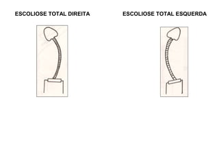 ESCOLIOSE TOTAL DIREITA   ESCOLIOSE TOTAL ESQUERDA
 