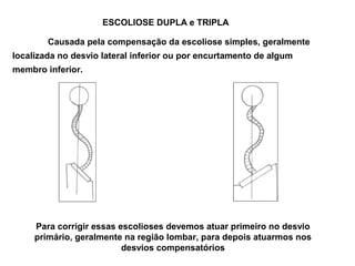 ESCOLIOSE DUPLA e TRIPLA

        Causada pela compensação da escoliose simples, geralmente
localizada no desvio lateral inferior ou por encurtamento de algum
membro inferior.




     Para corrigir essas escolioses devemos atuar primeiro no desvio
     primário, geralmente na região lombar, para depois atuarmos nos
                          desvios compensatórios
 