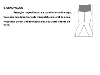 6. GENO VALGO
        Projeção do joelho para a parte interna do corpo.
Causada pela hipertrofia da musculatura lateral da coxa.
Necessita de um trabalho para a musculatura interna da
coxa.
 
